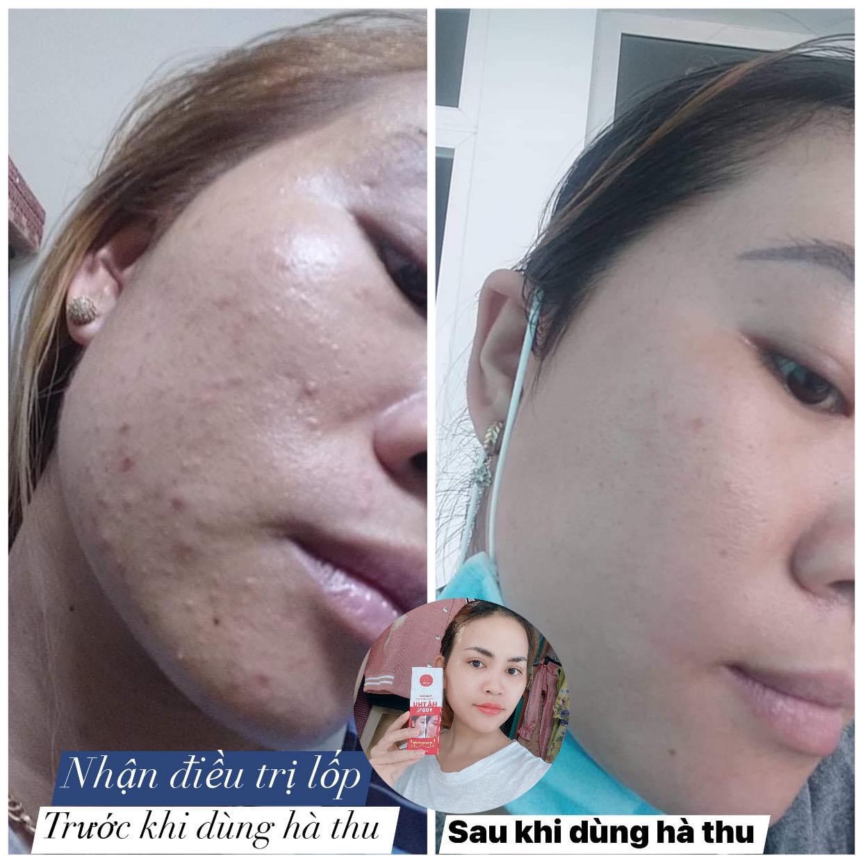 thuốc trị mụn da dầu